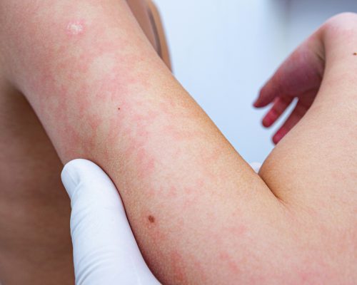 Redness and peeling of the skin on the body.